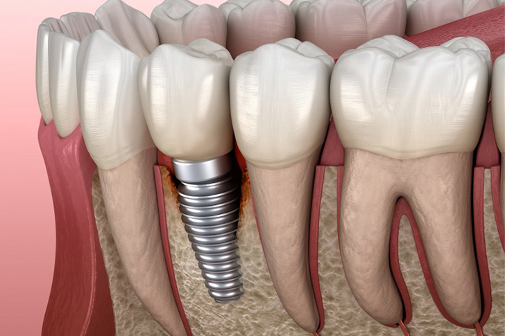 A Comprehensive Guide to Dental Implants and Oral Health