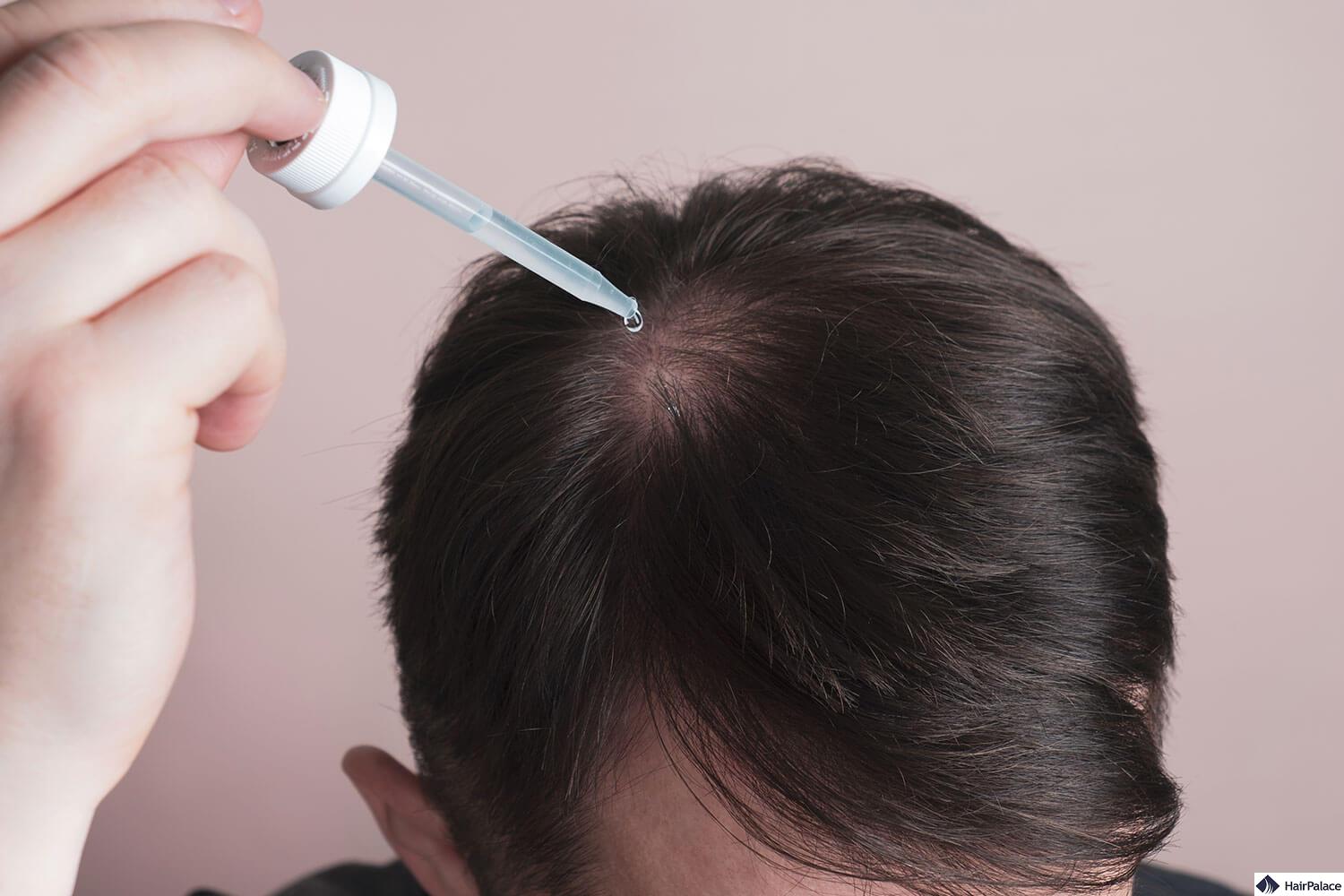 Effective Minoxidil Treatment for Hair Loss: A Comprehensive Guide
