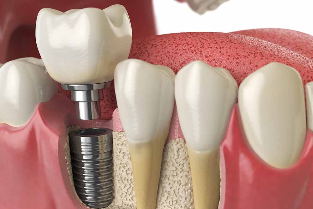 Comprehensive Guide to Dental Implants